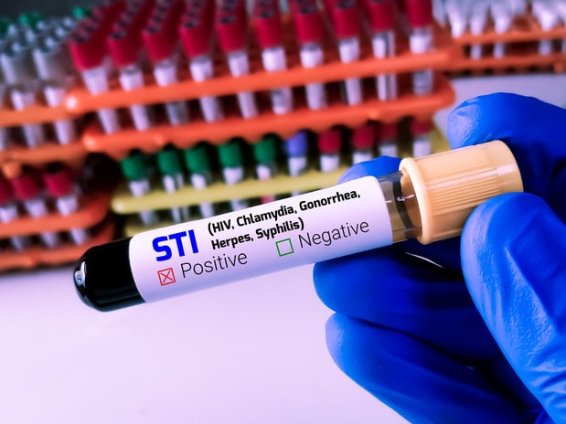 PrEP : y a-t-il un bénéfice clinique à traiter les IST asymptomatiques ? La réponse d'une étude belge