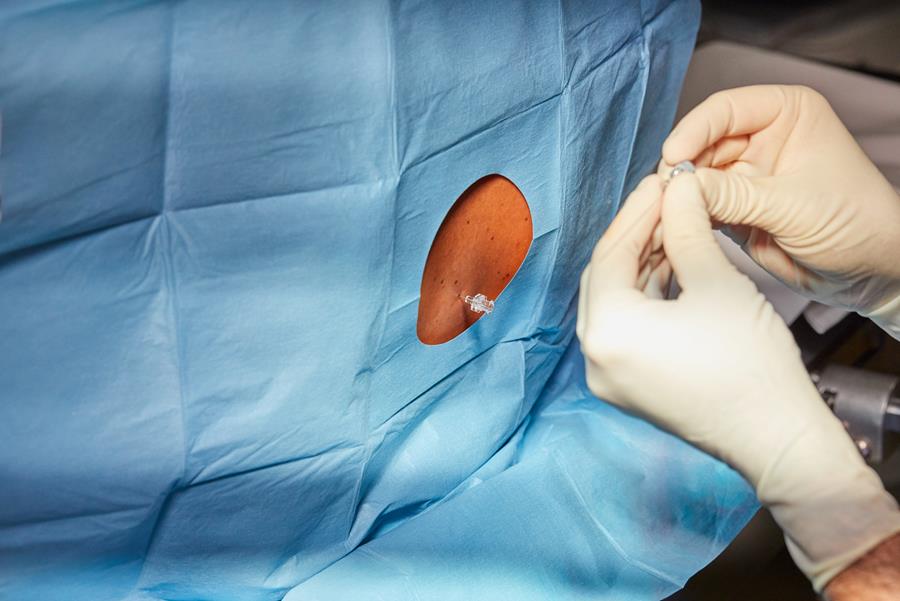 Péridurale ambulatoire : une innovation signée HUB