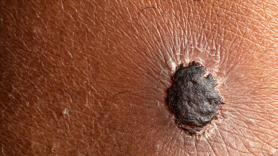 Neoadjuvante therapie bij reseceerbaar melanoom: een update