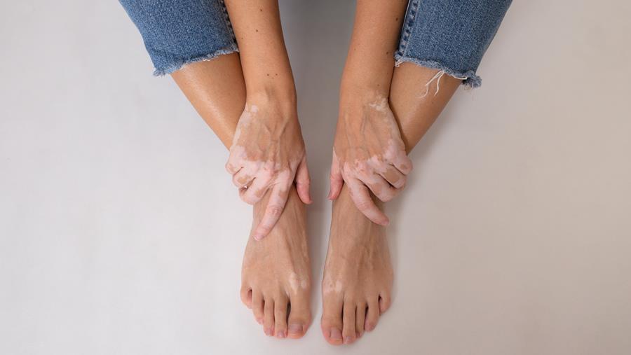 Vitiligo: duurzame werking van ruxolitinib-crème